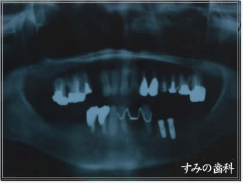 すみの歯科のインプラント