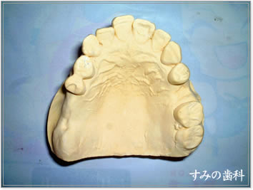 ノンクラスプデンチャー：一般歯科、小児歯科、ノンクラスプデンチャー、インプラント、ホワイトニング、訪問診療のすみの歯科